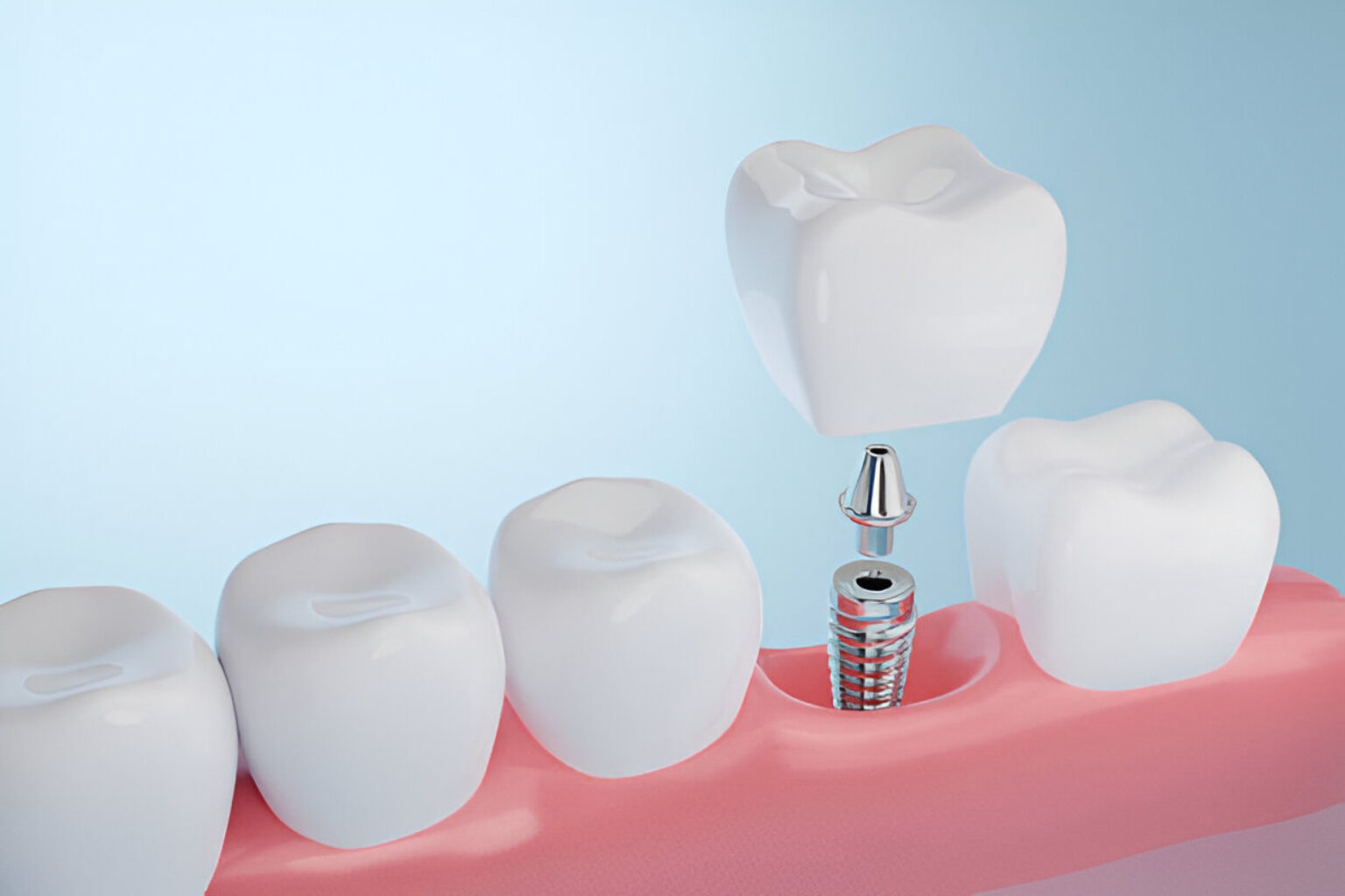 Dental Implants in Weston & Pembroke Pines, FL