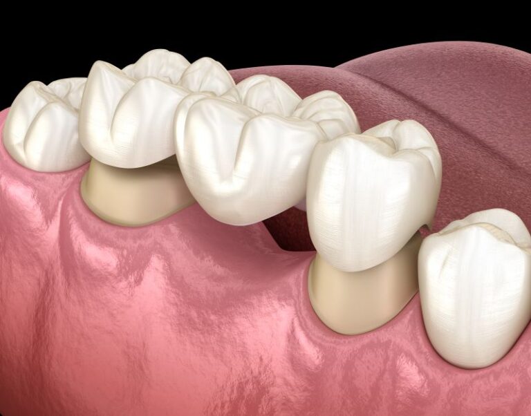 Dental Bridges in Weston & Pembroke Pines, FL