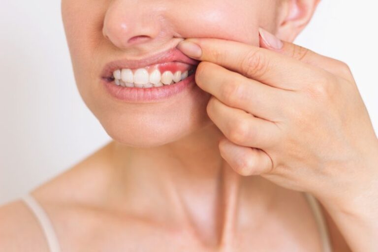 Gingivectomy Treatment in Weston & Pembroke Pines, FL