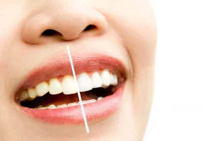 keep teeth white after whitening