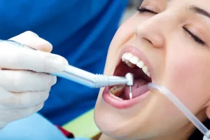 internal tooth bleaching after root canal